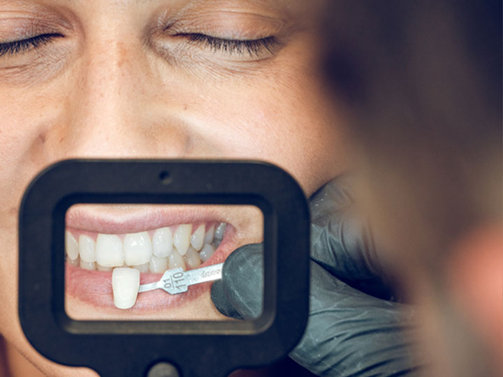 Beneficios De Las Carillas Dentales Clínica Dental Clavell